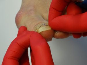 Nagelbeugel bij ingegroeide teennagel